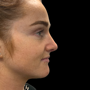 Ultrasonic-rhinoplasty-after